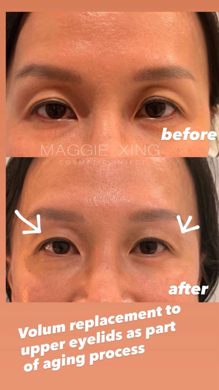 Upper Eyelid Volume Replacement