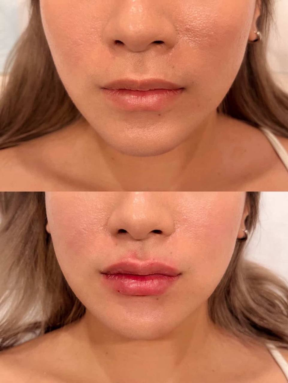 Lip Enhancement