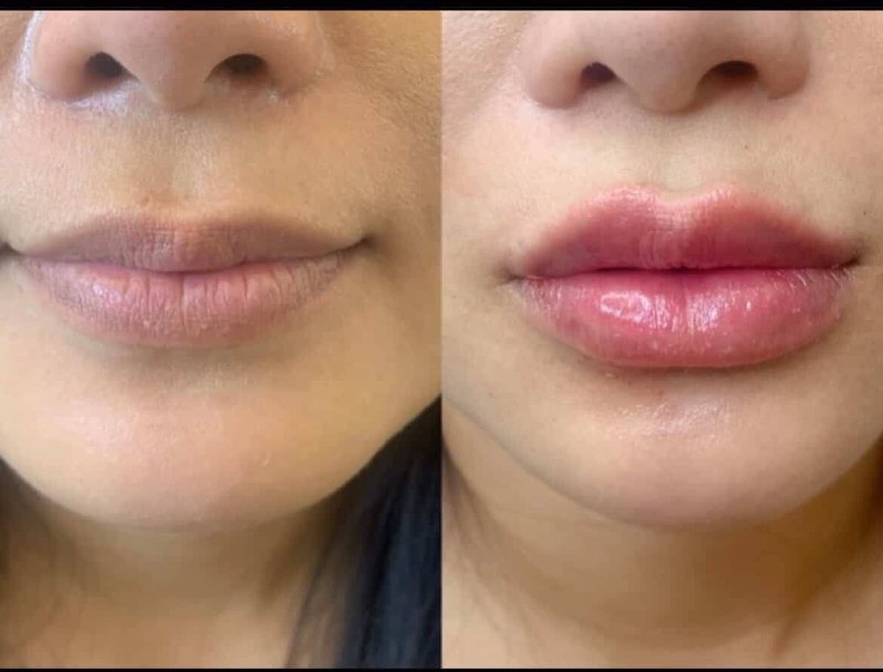 Lip Enhancement