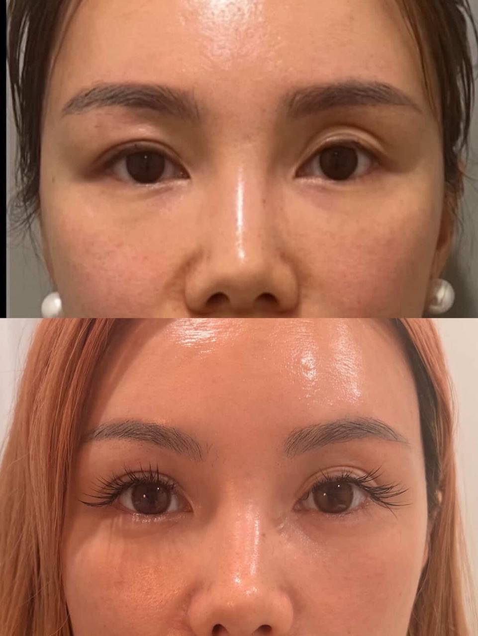 Upper Eyelid Hollows & Eye Rejuvenation