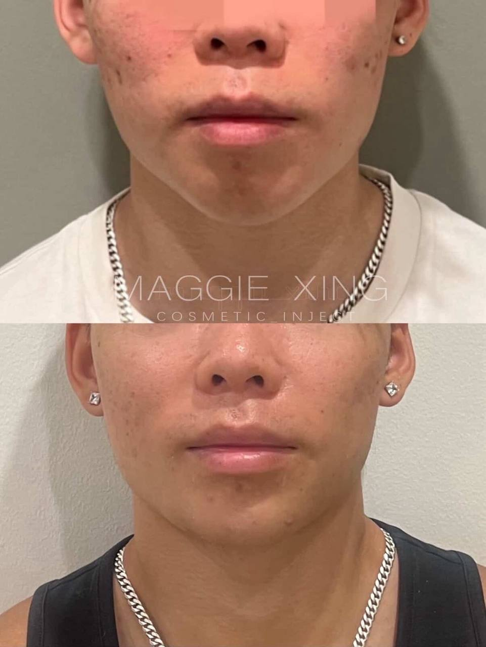 Male Chin Enhancement
